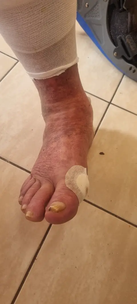 Péče o diabetickou nohu, fotografie 2