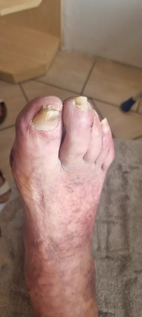 Péče o diabetickou nohu, fotografie 4