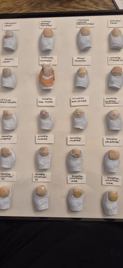 Ošetření zarostlého nehtu a nehtová rovnátka, fotografie 34